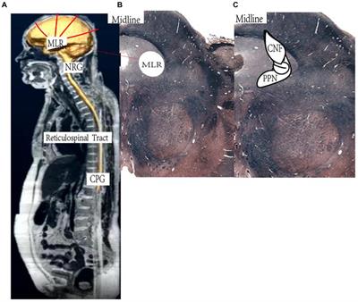 Efficacy and safety of deep brain stimulation in mesencephalic locomotor region for motor function in patients with post-stroke hemiplegia: a study protocol for a multi-center double-blind crossover randomized controlled trial